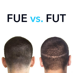 طرق زراعة الشعر