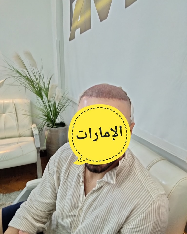 زراعة الشعر